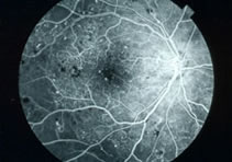K15 Macular Pucker