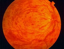 K37 Branch And Central Retinal Vein Occlusions