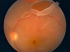 Retinal Tears And Detachments