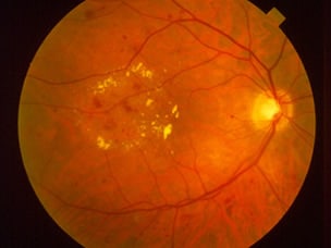 aao-K40 Diabetic Retinal Disease