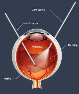 vitrectomy_000006467761XSmall